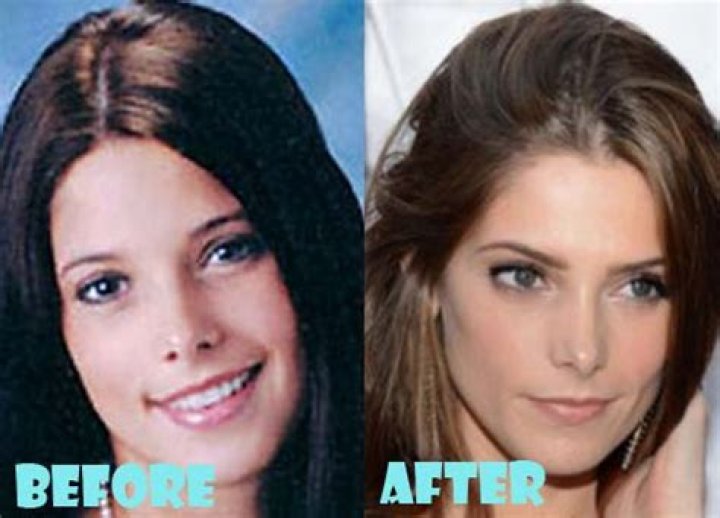 Ashley Greene Plastic Surgery Before and After