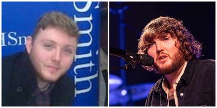 James Arthur Plastic Surgery: James's open admission to overcome childhood struggles!