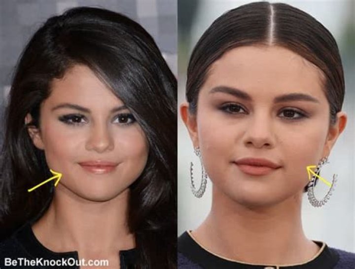 Selena Gomez Breast Implants Plastic Surgery Before and After